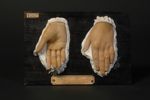 Dermite artificielle (Inv. 1922) des mains. Lésions trophiques des mains d'origine émotive (tentativ [...]