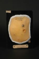 Syphilide ulcéro-gommeuse avec croûte rupioïde (Inv. 1922) du dos. Homme âgé de 29 ans, marchand de  [...]