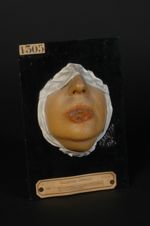 Chancre syphilitique de la lèvre inférieure, début de syphilides papuleuses concomitantes. Femme âgé [...]
