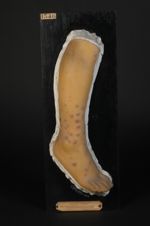 Lichen obtusus (Inv. 1922) de la jambe. Femme âgée de 21 ans
