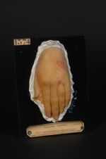 Lupus tuberculeux de la main ; ostéite de l'annulaire. Jeune fille âgée de 18 ans