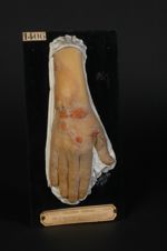 Lupus tuberculeux végétant de la main. Homme âgé de 30 ans, vigneron