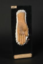 Syphilide psoriasiforme et eczématiforme de la paume de la main. Femme âgée de 42 ans, sans professi [...]