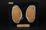 Lupus érythémateux symétrique des mains, développé depuis deux ans. Lupus chilblain de Hutchinson. J [...]