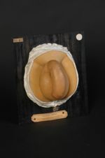 Urticaire oedémateuse de la verge et du scrotum. Homme âgé de 23 ans, cultivateur