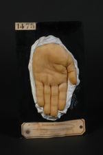 Erythème polymorphe à forme d'hydroa (Inv. 1922) sur la face palmaire de la main (il existait une se [...]