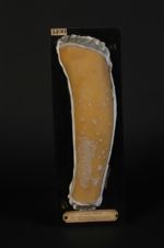 Syphilide papulo-squameuse psoriasiforme de la jambe, remarquable par l'épaisseur et l'aspect plâtre [...]