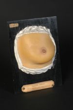 Sclérodermie en plaques ; morphée typique de la région mammaire. Femme âgée de 32 ans, ménagère. (Mo [...]