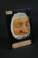 Épithéliome baso-cellulaire (Inv. 1922), forme térébrante, de la joue. Femme âgée de 42 ans