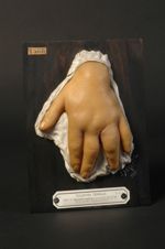 Hypertrophie congénitale de la main. Homme âgé de 54 ans, charretier. (Obs. in Bull. de la Soc. fr.  [...]