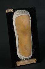 Leishmaniose cutanée (Inv. 1922). Bouton des pays chauds à la période cicatricielle, sur le genou d' [...]
