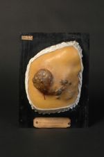 Naevo-carcinome. A gauche, tumeur ulcérée en champignon ; à droite, infiltration diffuse et tumeurs  [...]
