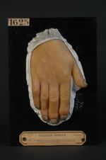 Eczéma primitif chronique des ongles ; poussée de vésicules discrètes péri-unguéales. Femme âgée de  [...]