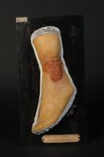 Ulcère gommeux syphilitique de la jambe gauche. Femme âgée de 40 ans, cuisinière