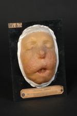 Lupus vulgaire de la totalité de la face, hypertrophique et mutilant, datant de l'enfance, forme mal [...]