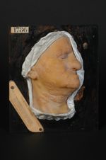 Plaques syphilitiques polymorphes, de la face et du cou, à forme circinée prédominante (Inv. 1922).  [...]