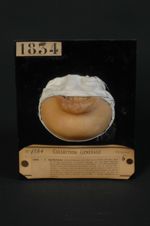 Epithéliome spino-cellulaire (Inv. 1922) de la lèvre. Homme âgé de 30 ans, terrassier