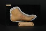 Lupus végétant (Inv. 1922) du pied. Homme âgé de 25 ans, boulanger. Tuberculose cutanée avec de nomb [...]