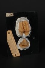 Plaques syphilitiques cutanées (Inv. 1922) ; syphilide papuleuse de la vulve et de la narine. Femme  [...]