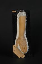 Varices congénitales des veines de l'avant-bras et de la main du côté gauche. Femme âgée de 30 ans,  [...]
