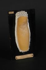 Pseudo-xanthome élastique (Obs. in C. R. du Congrès de dermatologie, 1896, et Monatschefte, 1896, pl [...]