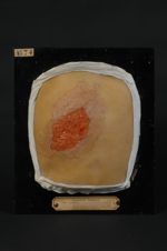 Epithéliome baso-cellulaire (tubulé atypique), forme superficielle dite pagetoïde (Inv. 1922). Homme [...]
