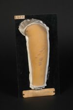 Lichen corné, ayant été compliqué d'impétigo par grattage (Inv. 1922). Homme âgé de 32 ans, courtier