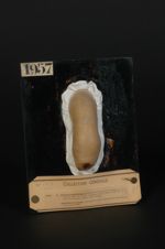 Plaques syphilitiques circinées du fourreau de la verge (Inv. 1922). Homme âgé de 27 ans, forgeron ( [...]