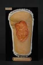 Épithéliome spino-cellulaire probable (Inv. 1922), développé sur une cicatrice de brûlure. Forme ser [...]