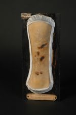 Syphilide tertiaire, forme hémorragique, de la jambe. Problablement, eschare provoquée (Inv. 1922).  [...]