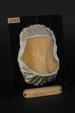Plaques syphilitiques (Inv. 1922) ;  syphilide secondaire papulo-circinée du cou. Femme âgée de 27 a [...]