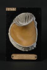 Eczéma séborrhéique. Eczématide figurée de Darier ; pityriasis stéatoïde de Sabouraud (Inv. 1922)