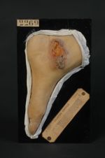 Épithéliome spino-cellulaire (Inv. 1922) développé sur un lichen corné. Homme âgé de 50 ans, serruri [...]
