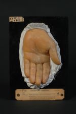 Eczéma kératosique probable de la paume de la main (Inv. 1922). Homme âgé de 39 ans