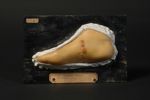 Sarcôme du pied chez une couturière, âgée de 45 ans ; vérifié deux fois par l'examen histologique. S [...]
