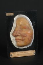 Éruption iodo-potassique du visage ; forme papuleuse et végétante. Femme âgée de 60 ans