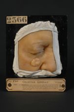 Epithéliome perlé (baso-cellulaire, lnv. 1922.) de la joue droite, avant traitement par les rayons X [...]