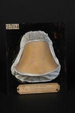 Leucomélanodermie syphilitique du cou, péri et post-papuleuse (moulage décoloré, Inv. 1922). Femme â [...]