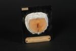 Kraurosis vulvae. Femme âgée de 67 ans