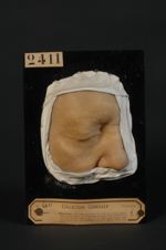 Epithéliome perlé (baso-cellulaire, Inv. 1922) de la joue droite, guéri par les rayons X. Homme âgé  [...]