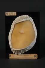 Épithéliome baso-cellulaire (Inv. 1922) du cou, à forme d'épithéliome plan cicatriciel. Femme âgée d [...]
