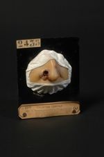 Èpithéliome naevique probable (Inv. 1922) du nez, récidivé deux à trois mois après avoir été guéri p [...]