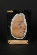Xeroderma pigmentosum avec épithéliome de la face. Femme âgée de 21 ans, domestique (Obs., par Balze [...]