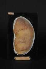 Lupus tuberculeux végétant (Inv. 1922), de la hanche. Homme âgé de 44 ans, commis. Tuberculose cutan [...]