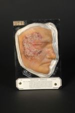 Blastomycose de la face, datant de vingt-huit mois. Homme âgé de 59 ans, tailleur. Le malade présent [...]