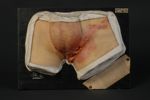 Granulome ulcéreux génito-crural, « groin ulcération ». Cas indigène. Début, à Paris, en octobre 191 [...]