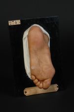 Porokératose papillomateuse des mains et des pieds. Homme âgé de 28 ans, menuisier