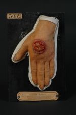 Épithéliome spino-cellulaire (lobulé typique ou épidermoïde) du dos de la main ; consécutif à une co [...]
