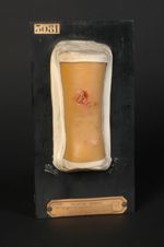Gomme hérédo-syphilitique de la jambe, développée sur une plaque d'érythémato-sclérose annulaire, co [...]