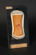 Gomme hérédo-syphilitique de la jambe. Fillette âgée de 13 ans, atteinte d'érythémato-sclérose annul [...]